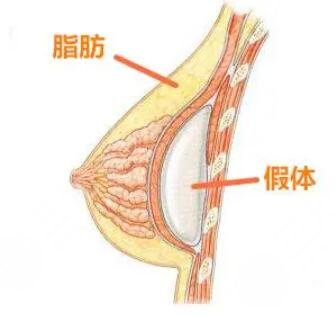 假體隆胸術(shù)后可以哺乳嗎?
