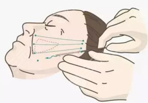 筋膜提升術(shù)多少錢？