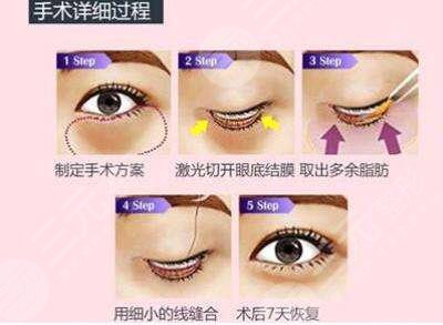 哈爾濱雅美整形醫(yī)療美容醫(yī)院價格表更新！去眼袋術(shù)后點評，避坑！