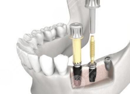 紐百特NEO種植牙