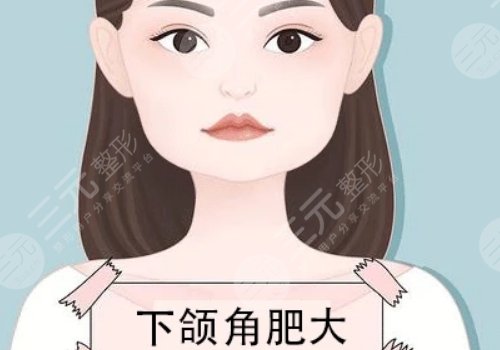 下顎整容手術(shù)一般要多少錢