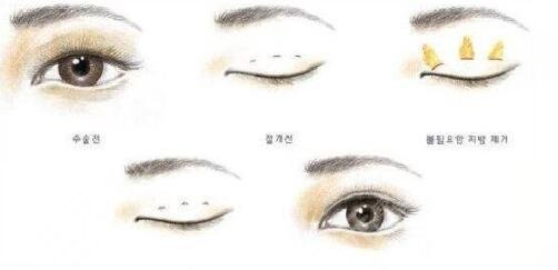 北京中關(guān)村醫(yī)院雙眼皮案例分享