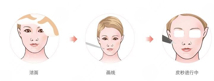 中關村醫(yī)院光子嫩膚案例分享