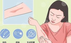 打了4次針疙瘩疤痕又長了怎么辦？祛疤修復(fù)指南！
