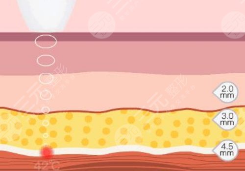 半島超聲炮的功效和作用