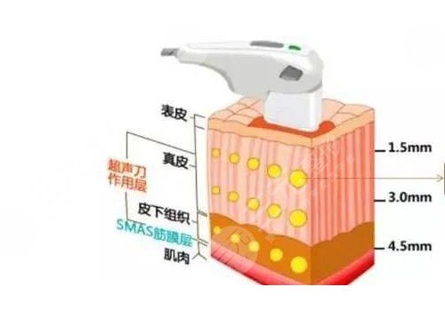 半島超聲炮的功效和作用