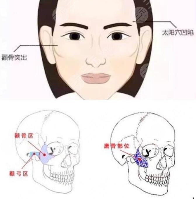 北京磨骨醫(yī)生張立天做的磨骨手術(shù)案例，坐診醫(yī)院_術(shù)后點(diǎn)評(píng)
