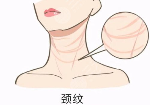 頸部皮膚松弛有什么辦法可以改良？