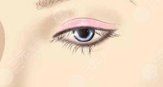 樸相根醫(yī)生做雙眼皮案例分享