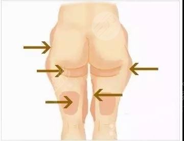 曾德浩醫(yī)生吸脂怎樣？簡介&案例測評！廣州荔醫(yī)高人氣之選~