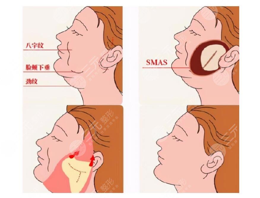 下頜線模糊下垂肉多怎么改良？