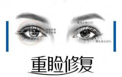 雙眼皮修復(fù)可以做綜合嗎？失敗別灰心，科普小課堂助你重塑！