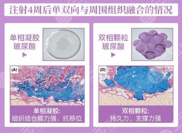婕爾玻尿酸有后遺癥嗎？