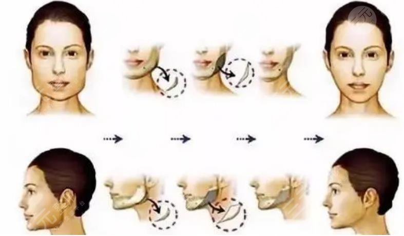 崔榮達醫(yī)生磨骨案例分享