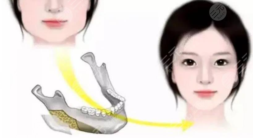 崔榮達醫(yī)生磨骨案例分享