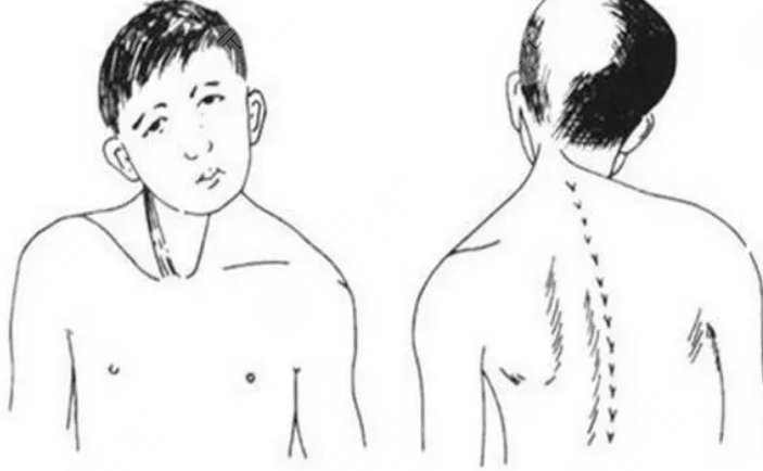 斜頸手術(shù)案例