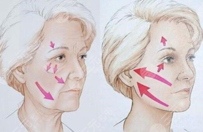 盧九寧醫(yī)生拉皮案例