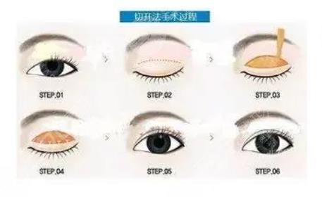 沈國(guó)雄醫(yī)生雙眼皮案例