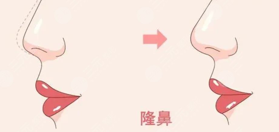 王榮錫醫(yī)生隆鼻案例