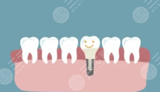 牙齒種植