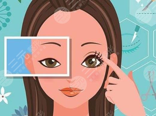 唐鏖醫(yī)生雙眼皮案例