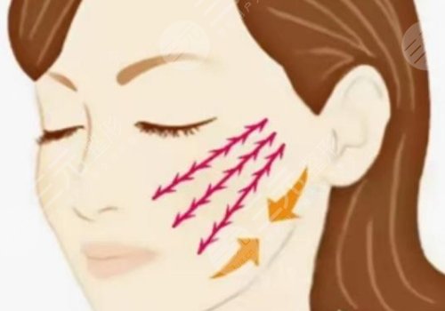 筋膜懸吊提升術(shù)能保持多久