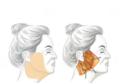 筋膜懸吊提升術(shù)能保持多久