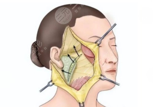 筋膜懸吊面部提升術(shù)價格是多少？