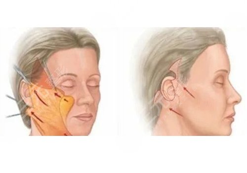 筋膜懸吊面部提升術(shù)價格