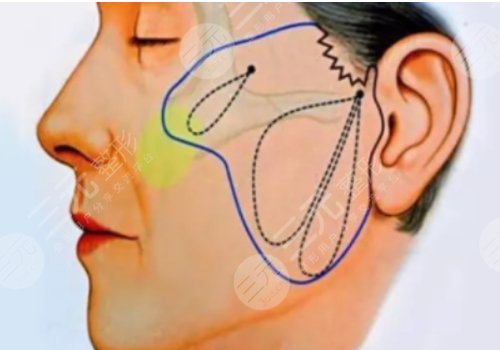 筋膜懸吊面部提升術(shù)價格