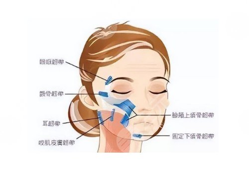 小切口拉皮手術(shù)費多少錢