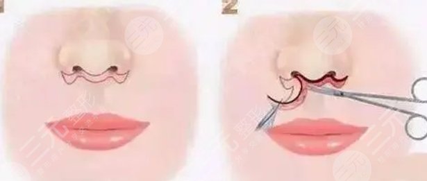 盧九寧醫(yī)生人中案例