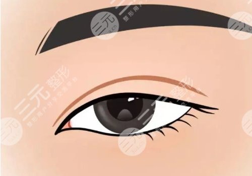 小切口雙眼皮能堅持幾年