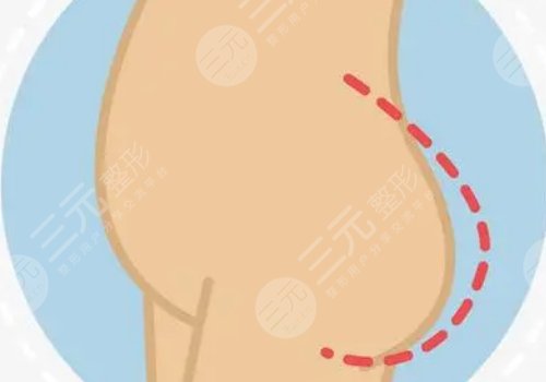 脂肪豐臀多久能恢復(fù)好？