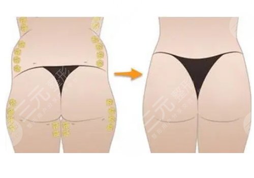脂肪豐臀多久能恢復(fù)好？