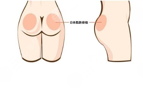 脂肪豐臀多久能恢復(fù)好？