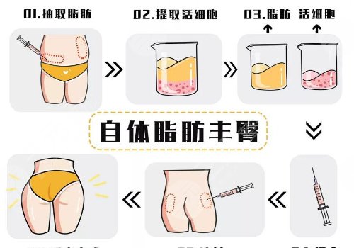 脂肪豐臀多久能恢復(fù)好