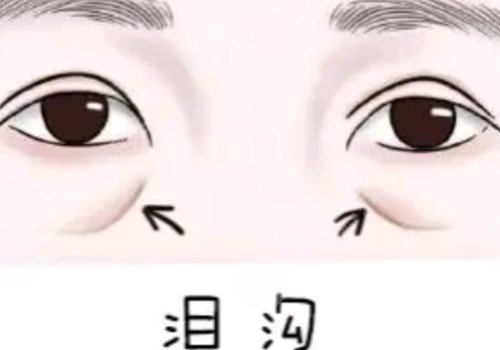 淚溝凹陷怎么解決好？
