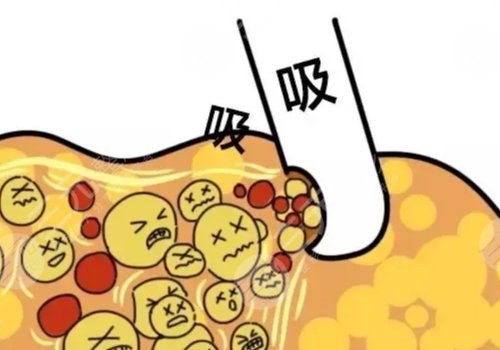 淚溝凹陷怎么解決好