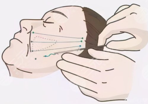 筋膜懸吊術(shù)可以維持幾年？