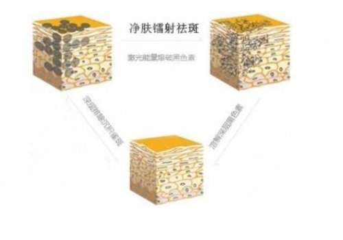 鐳射凈膚儀祛斑會(huì)反彈嗎