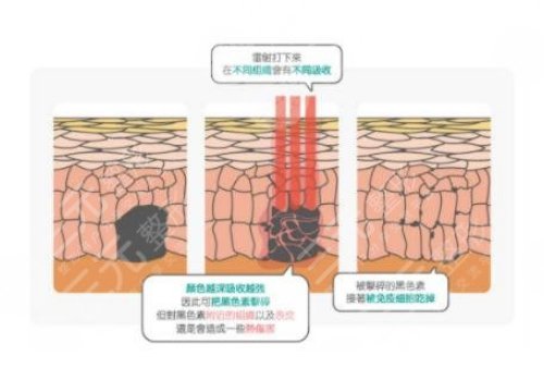 鐳射凈膚儀祛斑會(huì)反彈嗎