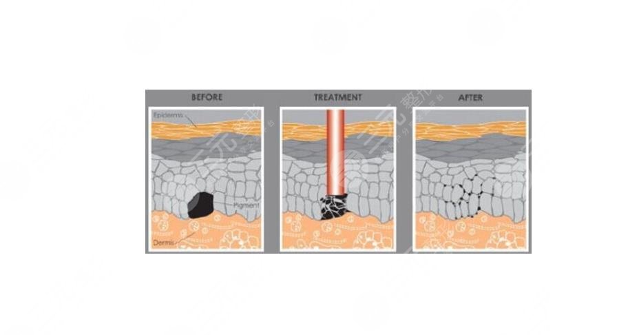 陳立彬?醫(yī)生做疤痕切除手術(shù)好嗎?