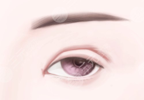 莊蔚強(qiáng)醫(yī)生雙眼皮案例