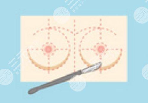 曼托假體好不好？