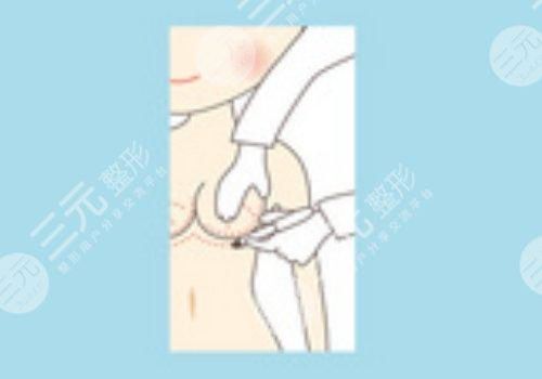 曼托假體好不好？