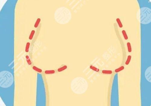 曼托假體好不好？