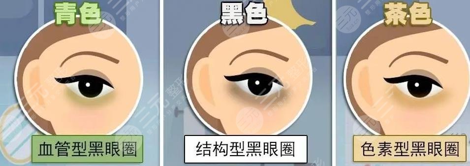 黑眼圈去除手術(shù)多久恢復(fù)