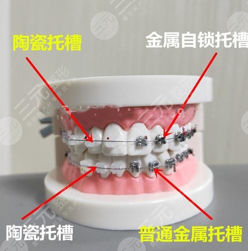 矯正牙齒用金屬的好還是隱形的好？科普分析，2種優(yōu)缺點(diǎn)對(duì)比！