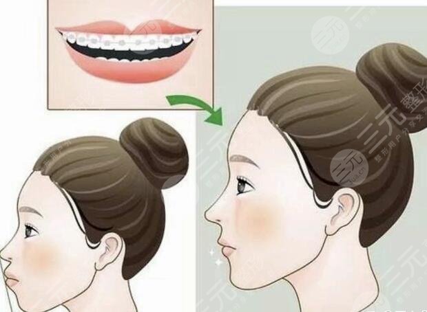 北京大學(xué)第三醫(yī)院牙齒正畸案例參考